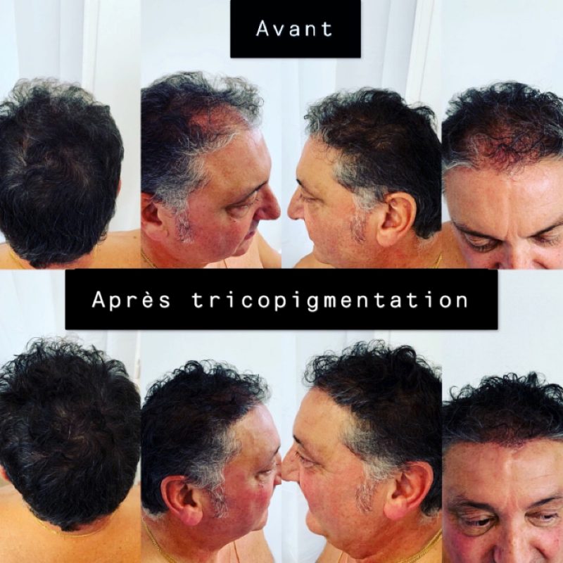 tricopigmentation avant-après